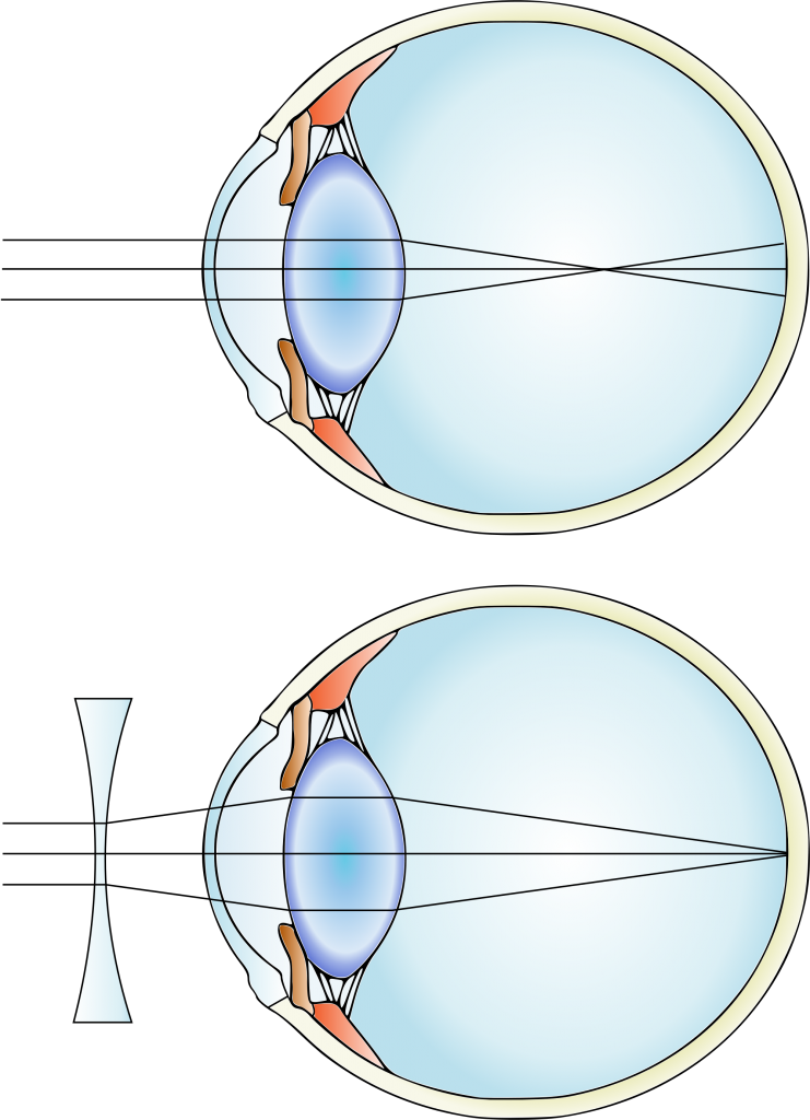 Miopía y lente correctora